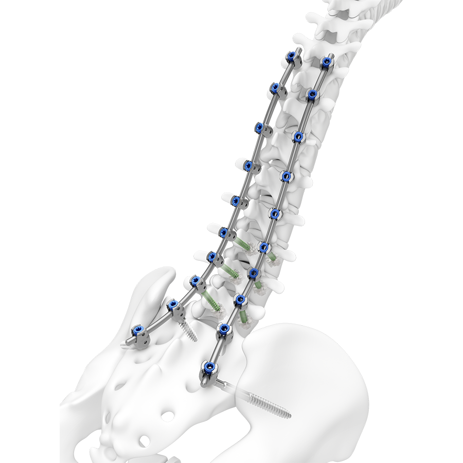 TriALTIS™ Spine System 
