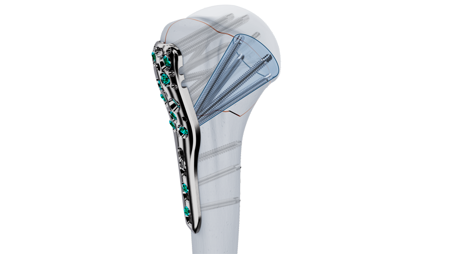 VOLT Proximal Humerus Plating System